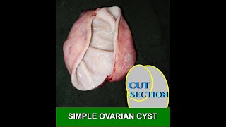 SIMPLE OVARIAN CYST [upl. by Carolina203]