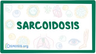 Sarcoidosis  causes symptoms diagnosis treatment pathology [upl. by Tichon380]