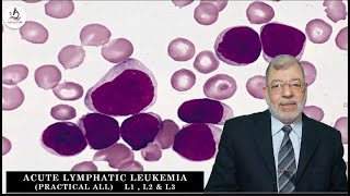 Acute Lymphoblastic Leukemia 13 ALL Practical [upl. by Hukill]