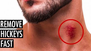 Best Ways to Get Rid of or Hide a Hickey  Remove a Hickey Fast  Tiege Hanley [upl. by Adnaloy]