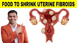 FOOD THAT WILL SHRINK UTERINE FIBROIDS  DR VIVEK JOSHI [upl. by Ainavi]