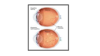 Diabetic Retinopathy Video No 495 [upl. by Ateerys]