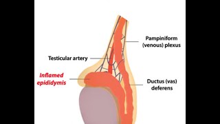 Epididymitis [upl. by Rezal]