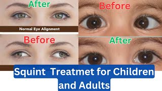 SquintStrabismus  Causes Types amp Treatments For Children amp Adults  Eye caretaker [upl. by Adiaroz]