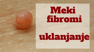 Šta su dermatofibromi meki fibromi i kako se uklanjaju [upl. by Tacy]