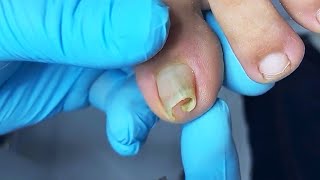 Removal of severely curved ingrown toenail  Satisfying video [upl. by Notnirb578]