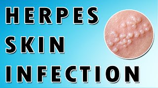 Herpes Simplex Virus Symptoms and Treatment [upl. by Sherard]