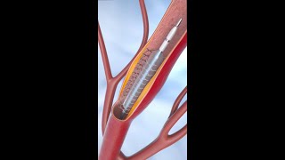 Coronary Angioplasty and Stent Insertion animation shorts anatomy science asmr [upl. by Lesnah]