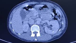 Acute pyelonephritis  CT findings [upl. by Luhar]