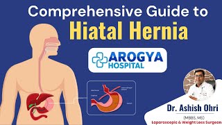 Comprehensive Guide to Hiatal Hernia  Types Symptoms and Treatment by Dr Ashish Ohri [upl. by Ahsinwad]