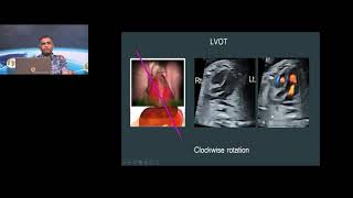 GE Webinar Fetal Echocardiography Practical Guideline  Dr BS Rama Murthy [upl. by Ahsea830]