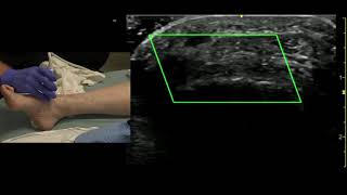 Ultrasound of the Dorsalis Pedis Artery [upl. by Saraiya]