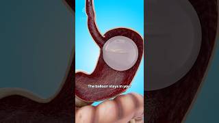 How a Gastric Balloon Helps with Weight Loss 😮  shorts viralvideo  Creativelearning3d [upl. by Aerbua]