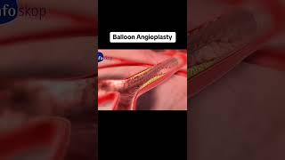 balloon angioplastyshortvideo viral [upl. by Atinot]