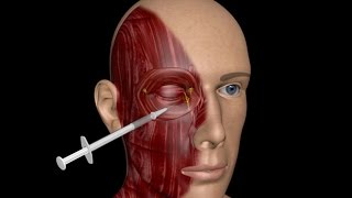 3D MEDICAL TRAINING PROGRAM  BLEPHAROSPASM TREATMENT [upl. by Imoian]