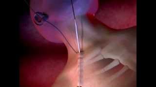 ProGuide™ Chronic Dialysis Catheters Animation [upl. by Neeka]