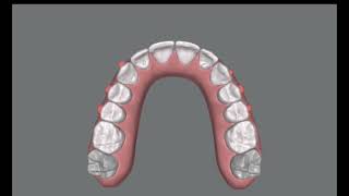 Simple alignment with Invisalign clincheck project ready to send to the patient [upl. by Juanne]