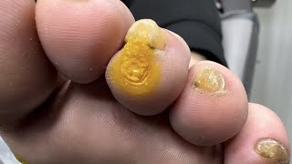 Removal of Multiple Warts and Calluses [upl. by Mureil]