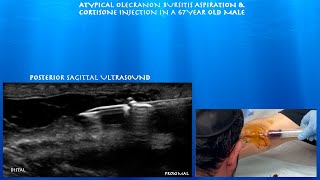 Ultrasound Guided Atypical Olecranon Bursitis Aspiration and Cortisone Injection by probeultrasound [upl. by Delija]