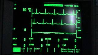 ECG  EKG paroxysmal supraventricular tachycardia holiday heart syndrome vs sick sinus syndrome [upl. by Nahsab735]