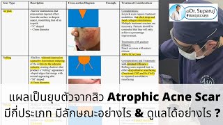 แผลเป็นยุบตัวจากสิว Atrophic Acne Scar มีกี่ประเภท มีลักษณะอย่างไร amp ดูแลได้อย่างไร [upl. by Annawt700]