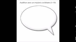 Comment on entend avec un implant cochléaire  Vidéo n°4 Normal J0 J10 J30 [upl. by Inig]