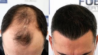 Injerto Capilar FUE 3070 Injertos  Alopecia NW V Dr Couto  FUEXPERT CLINIC  Recuperar Pelo [upl. by Prud]