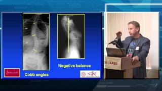 Spinal Deformity Overview [upl. by Gib]