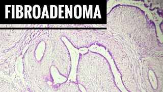 Fibroadenoma Histopathology [upl. by Lajet958]