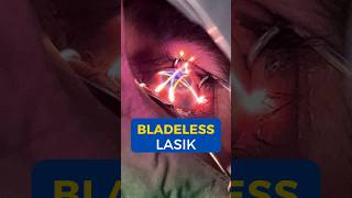 What Is Bladeless Lasik Surgery I Live Bladeless Lasik Surgery [upl. by Schnorr]