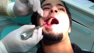 Third molar Extraction wisdom tooth [upl. by Yenterb390]