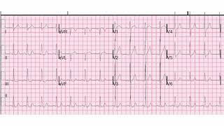 Difference Between AFIB and VFIB and SVT [upl. by Lunn]