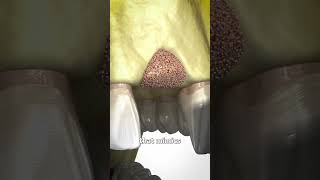 Bone Grafting Explained 🤔 [upl. by Ardnoed585]