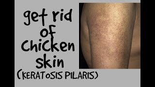 HOW TO GET RID OF CHICKEN SKIN KERATOSIS PILARIS DR DRAY [upl. by Madea63]