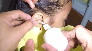 Removal of Hard Clogged Stubborn Earwax by Ear Irrigation [upl. by Edivad561]