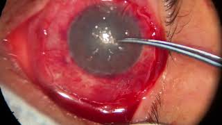 Simple Epithelial Limbal Transplant  Trasplante Simple de Células Limbares [upl. by Van268]