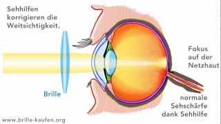 Was ist Weitsichtigkeit Hyperopie [upl. by Krystle]