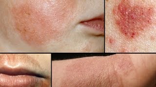 Eczema Atopic Dermatitis  What is Eczema Pictures and How To Treat Eczema [upl. by Mavilia]