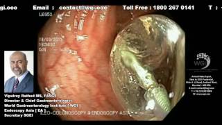 Endoscopic procedure of colonic balloon dilatation [upl. by Dymoke208]