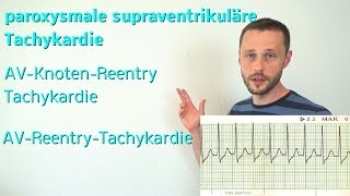 Die supraventrikuläre Tachykardie AVKnotenReentry und AVReentryTachykardie [upl. by Eilyab]