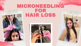 I Tried Microneedling For My Hair Loss [upl. by Weintrob]