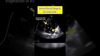 InterAtrial septal Aneurysm on Echocardiography echo heart [upl. by Nawoj]