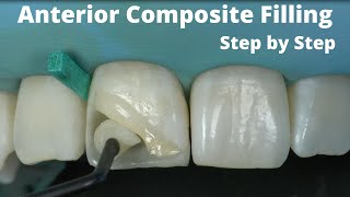 Anterior Incisor Composite Esthetic Filling by Dentsply Neo Spectra St review Step by Step [upl. by Norihs]