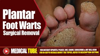 Foot Plantar Warts  Surgical Removal Treatment  How to Remove Plantar Warts ❌🦠 [upl. by Hekking]