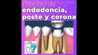 proceso de endodoncia [upl. by Talich]