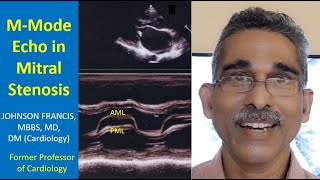 MMode Echo in Mitral Stenosis [upl. by Atinreb66]