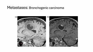 Diagnosing brain tumors can be a complex process [upl. by Ecinehs]