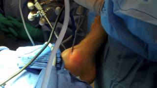 Ankle Arthroscopy [upl. by Dogs]