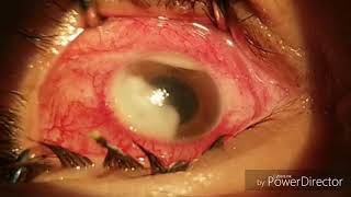 Fungal keratitis intrastromal antifungal therapy 2 [upl. by Lenni946]