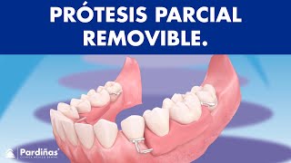 Prótesis parcial removible  ¿Cómo funcionan © [upl. by Enylekcaj]